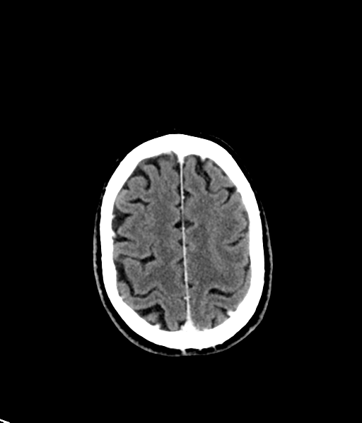 Brain metastasis (large cystic mass) (Radiopaedia 47497-52106 Axial C+ 48).png