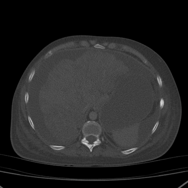 Breast cancer metastases - hepatic and skeletal (Radiopaedia 34201-35461 Axial bone window 36).jpg