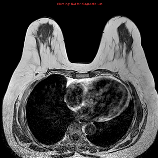 File:Breast carcinoma (multicentric multifocal in mammary Paget disease) (Radiopaedia 50966-56512 Axial T1 4).jpg