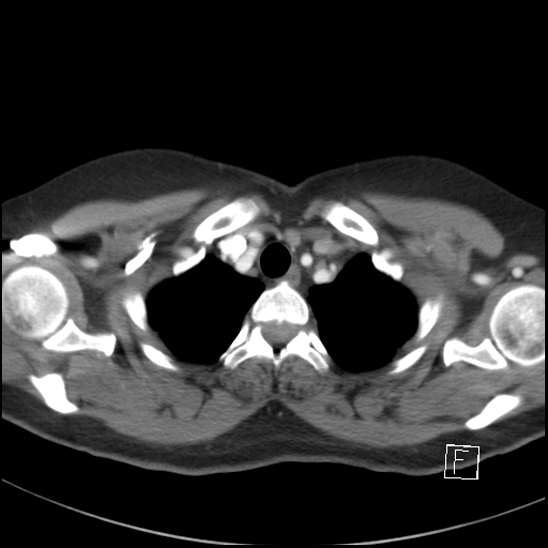 File:Breast metastases from renal cell cancer (Radiopaedia 79220-92225 A 13).jpg