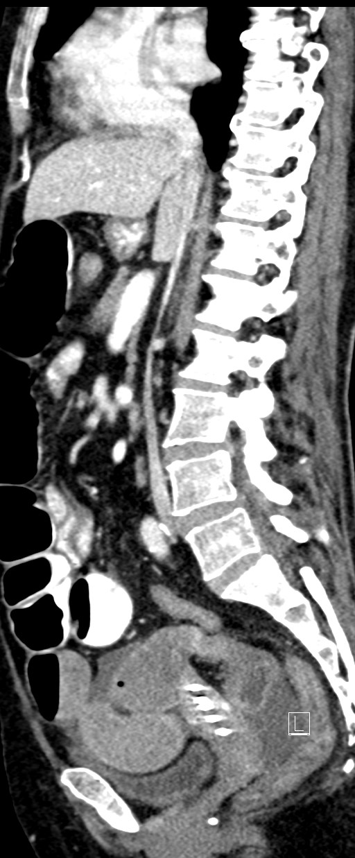 Broad ligament hernia (Radiopaedia 84802-100276 C 42).jpg