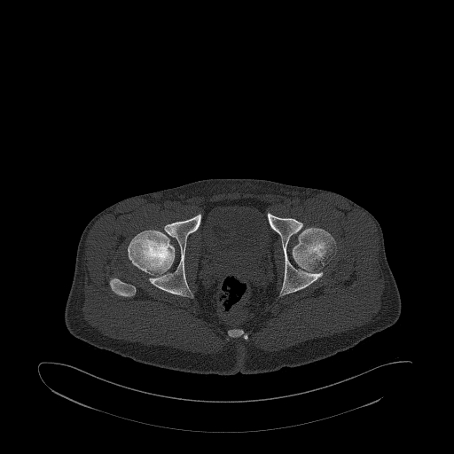 Brodie abscess- femoral neck (Radiopaedia 53862-59966 Axial bone window 149).jpg
