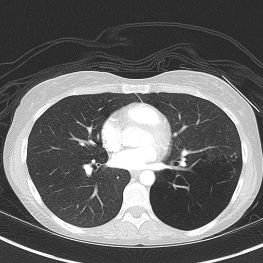 Bronchial atresia (Radiopaedia 73677-84470 Axial lung window 35).jpg