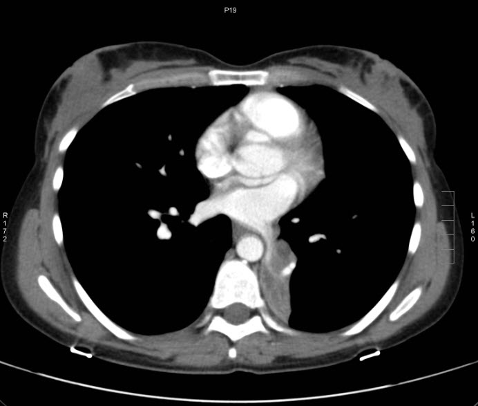 File:Bronchial carcinoid tumor (Radiopaedia 15042-42507 B 8).jpg