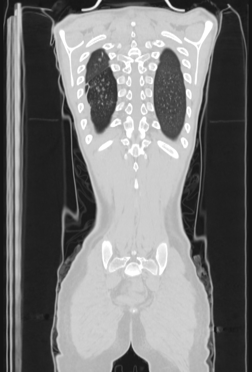 Bronchial carcinoid tumor (Radiopaedia 57187-64090 Coronal lung window 99).jpg