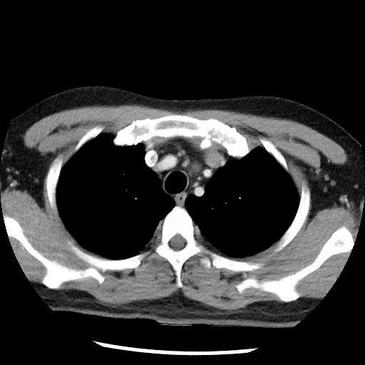 Bronchial carcinoid tumor (Radiopaedia 67377-76764 A 15).jpg