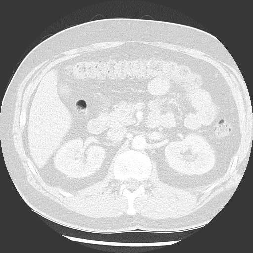 Bronchial carcinoid tumor (Radiopaedia 67377-76764 Axial lung window 71).jpg