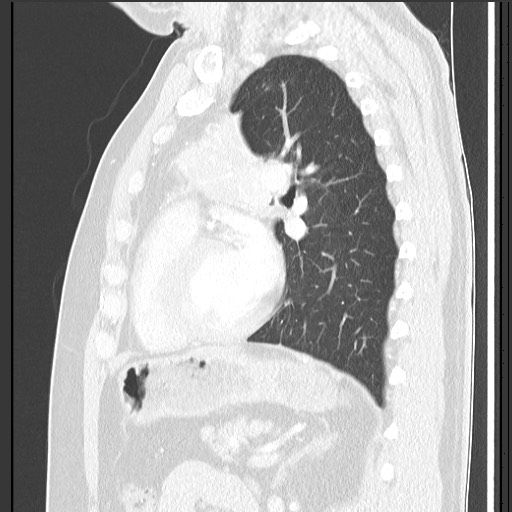 Bronchial carcinoid tumor (Radiopaedia 67377-76764 Sagittal lung window 44).jpg