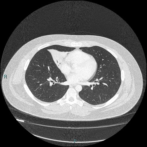 Bronchial carcinoid tumor (Radiopaedia 78272-90875 Axial lung window 29).jpg