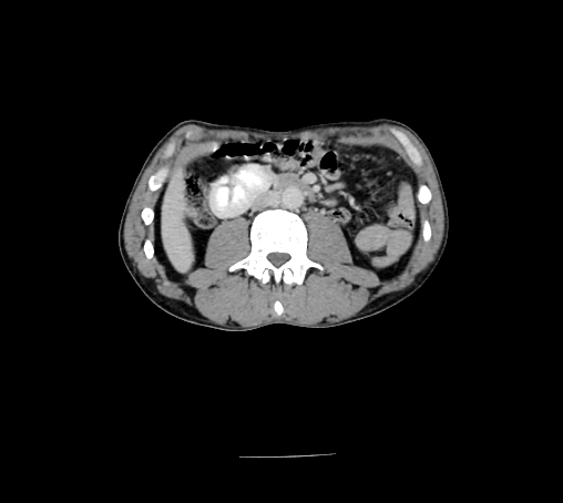 File:Bronchiectasis in Crohn disease (Radiopaedia 60311-67977 B 86).jpg
