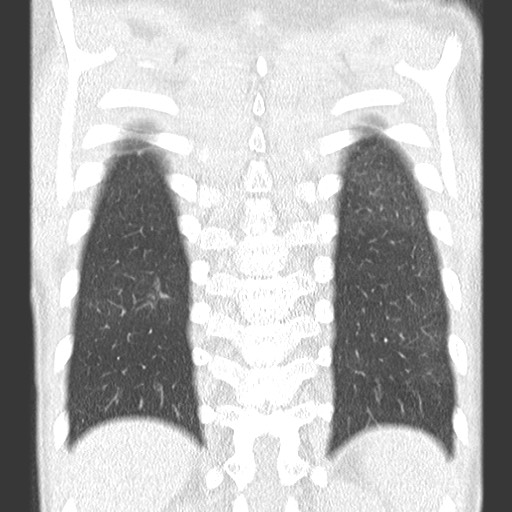 File:Bronchiolotis obliterans (Radiopaedia 73769-84575 Coronal lung window 33).jpg