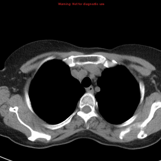 File:Bronchoalveolar carcinoma (BAC) (Radiopaedia 13436-13392 Axial non-contrast 10).jpg