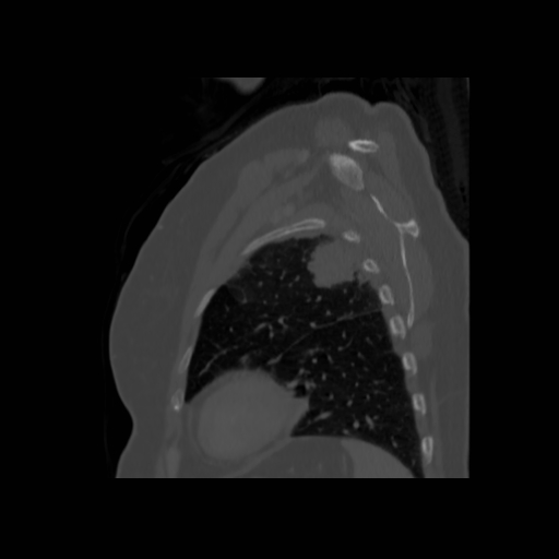 Bronchogenic carcinoma (Radiopaedia 73497-84262 Sagittal bone window 123).jpg