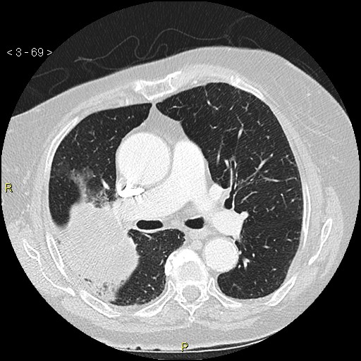 Bronchogenic carcinoma as an incidental finding (Radiopaedia 16453-16130 Axial lung window 69).jpg