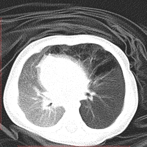 Bronchogenic cyst (Radiopaedia 78599-91409 Axial lung window 77).jpg