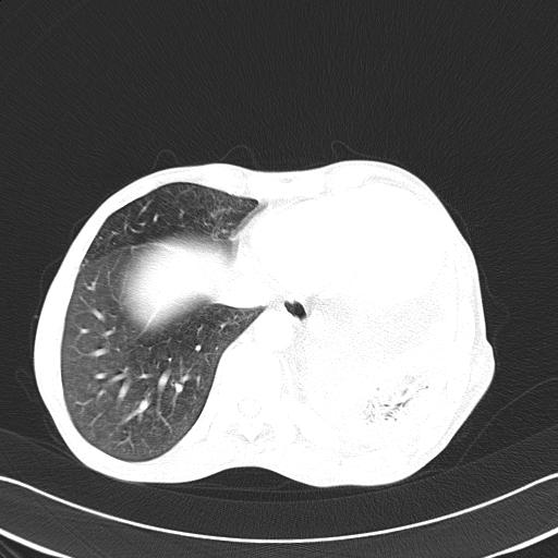 Bronchopleural fistula secondary to tuberculosis (Radiopaedia 20415-20322 Axial lung window 45).jpg