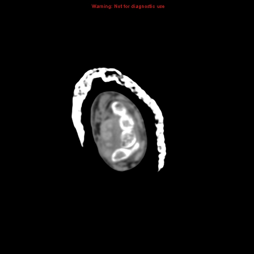Brown tumor (Radiopaedia 12460-12694 Axial non-contrast 9).jpg