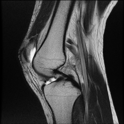 File:Bucket-handle meniscus tear (Radiopaedia 65700-74809 Sagittal T2 12).jpg