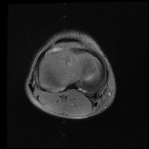 File:Bucket handle tear - lateral meniscus (Radiopaedia 72124-82634 Axial PD fat sat 11).jpg