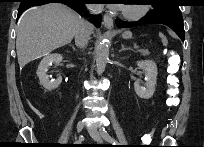 Buried bumper syndrome - gastrostomy tube (Radiopaedia 63843-72577 Coronal Inject 77).jpg
