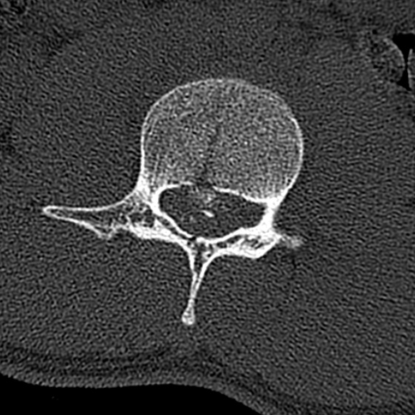 Burst fracture (Radiopaedia 53373-59357 Axial bone window 35).jpg