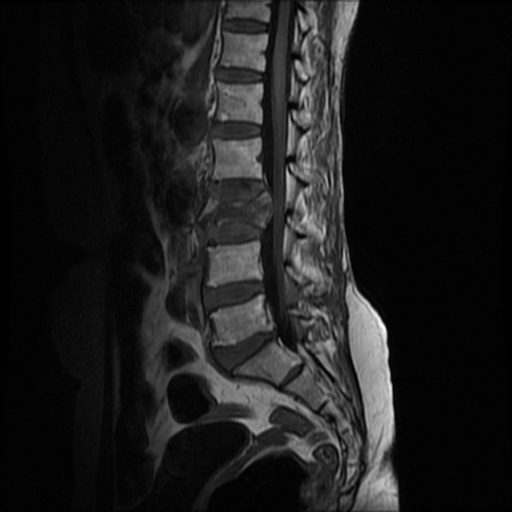 File:Burst fracture - lumbar spine (Radiopaedia 72877-83541 Sagittal T1 5).jpg