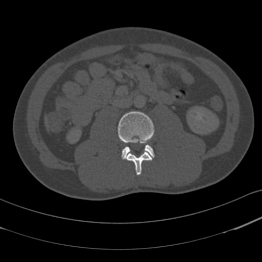 Burst fracture with cauda equina syndrome (Radiopaedia 25701-25867 Axial bone window 76).jpg