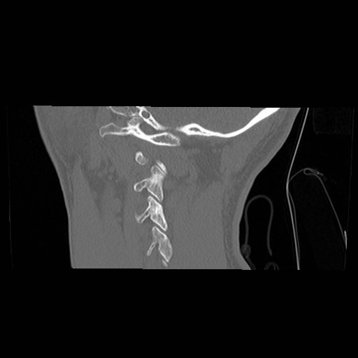 File:C1-C2 "subluxation" - normal cervical anatomy at maximum head rotation (Radiopaedia 42483-45607 C 8).jpg
