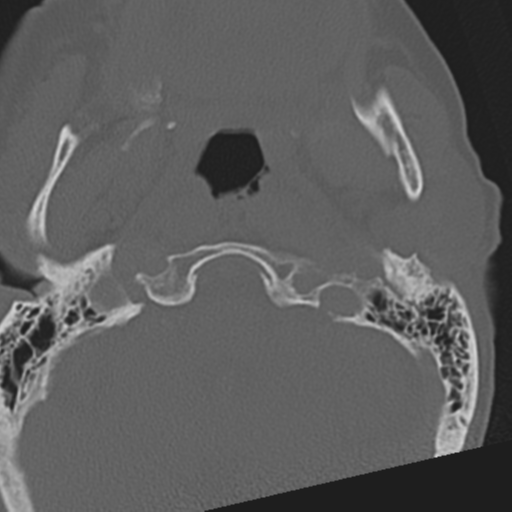 File:C2 fracture with vertebral artery dissection (Radiopaedia 37378-39199 Axial bone window 6).png