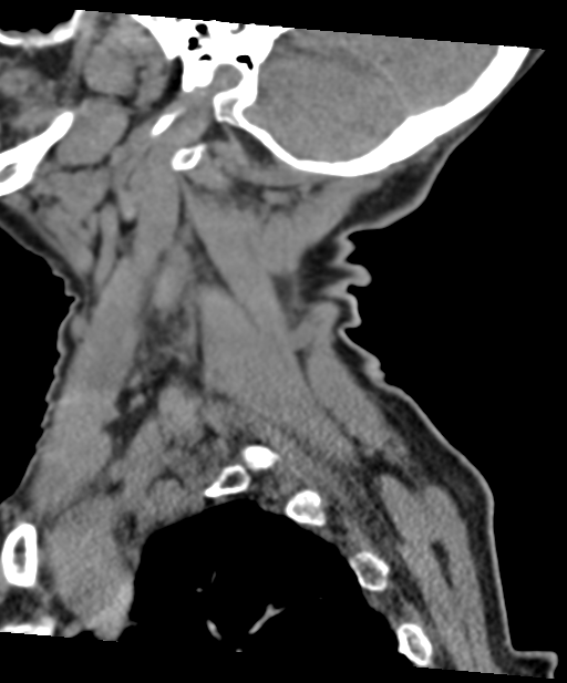 C2 fracture with vertebral artery dissection (Radiopaedia 37378-39199 D 65).png
