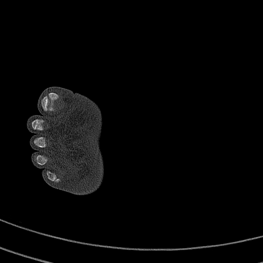 Calcaneal fracture - Sanders type 4 (Radiopaedia 90179-107370 Axial bone window 65).jpg