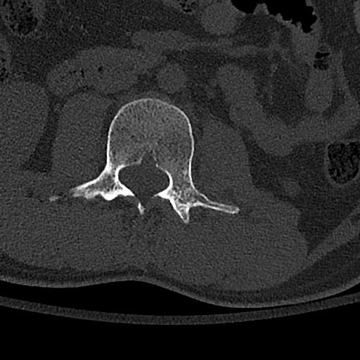 Calcaneal fractures with associated L2 burst fracture (Radiopaedia 71671-82493 Axial bone window 73).jpg