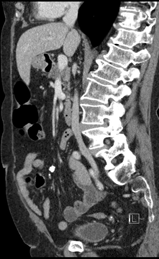 Calcified adrenal glands and Spigelian hernia (Radiopaedia 49741-54988 C 91).jpg
