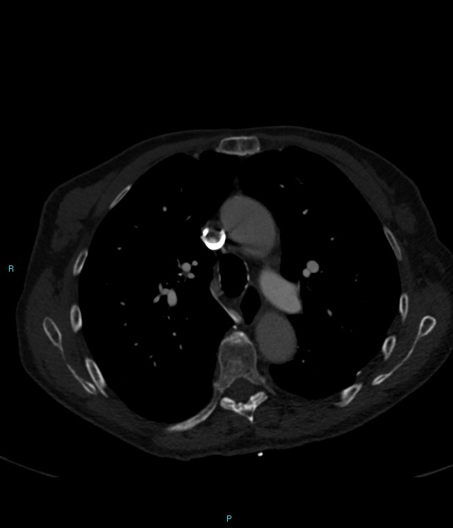 Calcified cerebral emboli from left ventricular thrombus (Radiopaedia 84420-99760 Axial bone window 29).jpg