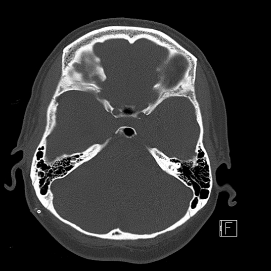 File:Calcified chronic subdural hematoma (Radiopaedia 77374-89492 Axial bone window 36).jpg