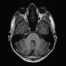 Callosal dysgenesis with interhemispheric cyst (Radiopaedia 53355-59335 Axial T1 40).jpg