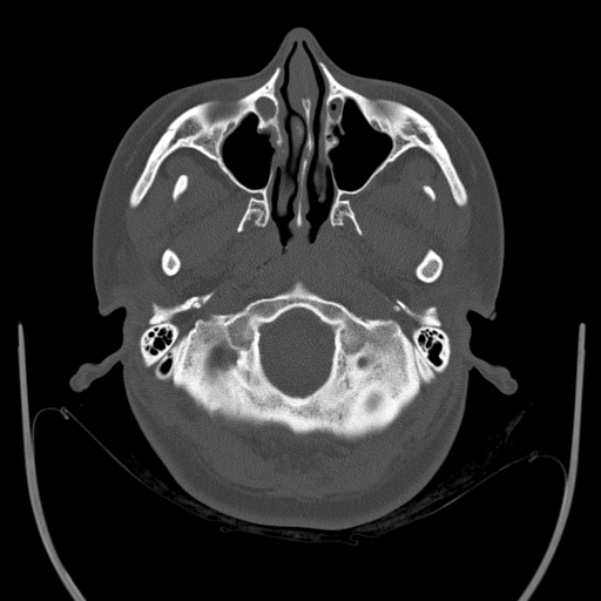 Calvarial osteoma (Radiopaedia 36520-38079 Axial bone window 14).jpg