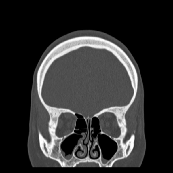 Calvarial osteoma (Radiopaedia 36520-38079 C 24).jpg