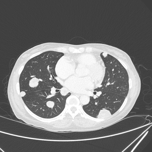 Canonball lung metastasis (Radiopaedia 77634-89837 Axial lung window 101).jpg