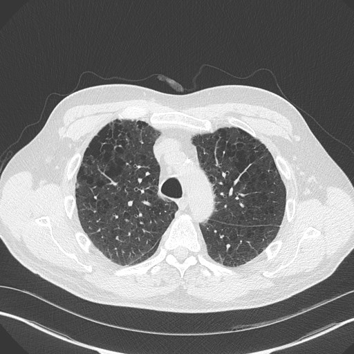 Caplan syndrome (Radiopaedia 56667-63530 Axial lung window 62).jpg