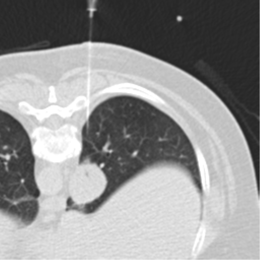 Carcinoid tumor - lung (Radiopaedia 44814-48644 Axial lung window 84).png