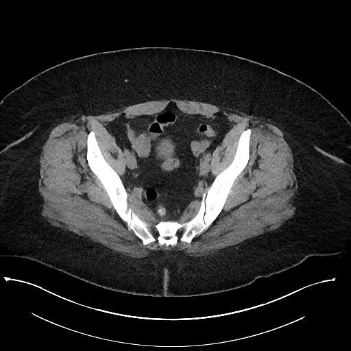 File:Carcinoid tumor - terminal ileum (Radiopaedia 60931-68740 Axial non-contrast 100).jpg