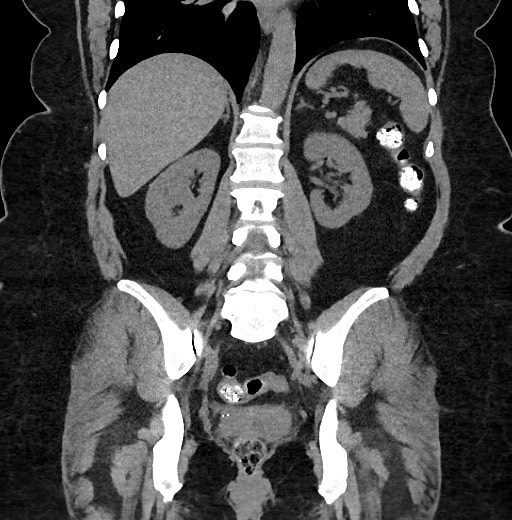 Carcinoid tumor - terminal ileum (Radiopaedia 60931-68740 Coronal non-contrast 72).jpg