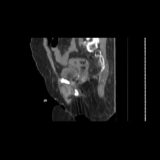 File:Carcinoma cervix- brachytherapy applicator (Radiopaedia 33135-34173 D 122).jpg