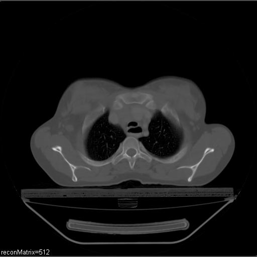 File:Carcinoma of esophagus (Radiopaedia 27356-27550 Axial bone window 27).jpg