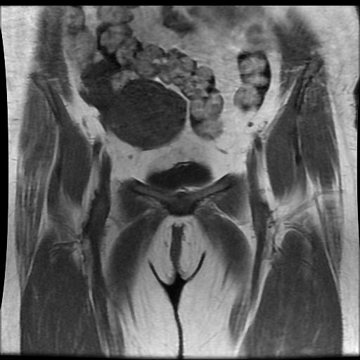 File:Carcinoma of the cervix (Radiopaedia 89018-105858 Coronal T1 2).jpg
