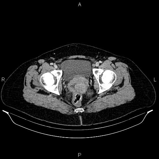 Carcinoma of uterine cervix (Radiopaedia 85861-101700 A 73).jpg
