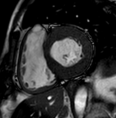 Cardiac amyloidosis - ATTR wild-type (Radiopaedia 74412-85296 short axis cine SSFP 147).jpg