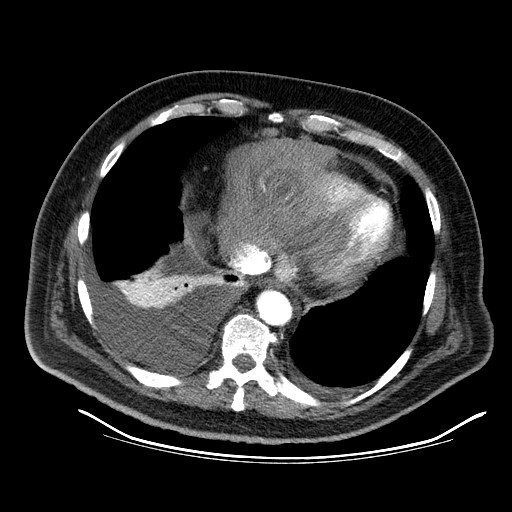 File:Cardiac lymphoma (Radiopaedia 38690-40836 Axial C+ CTPA 16).jpg