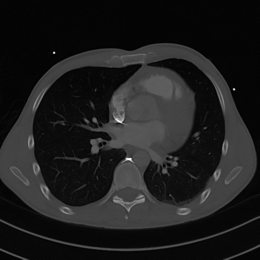 Cardiac tumor - undifferentiated pleomorphic sarcoma (Radiopaedia 45844-50134 Axial bone window 38).png